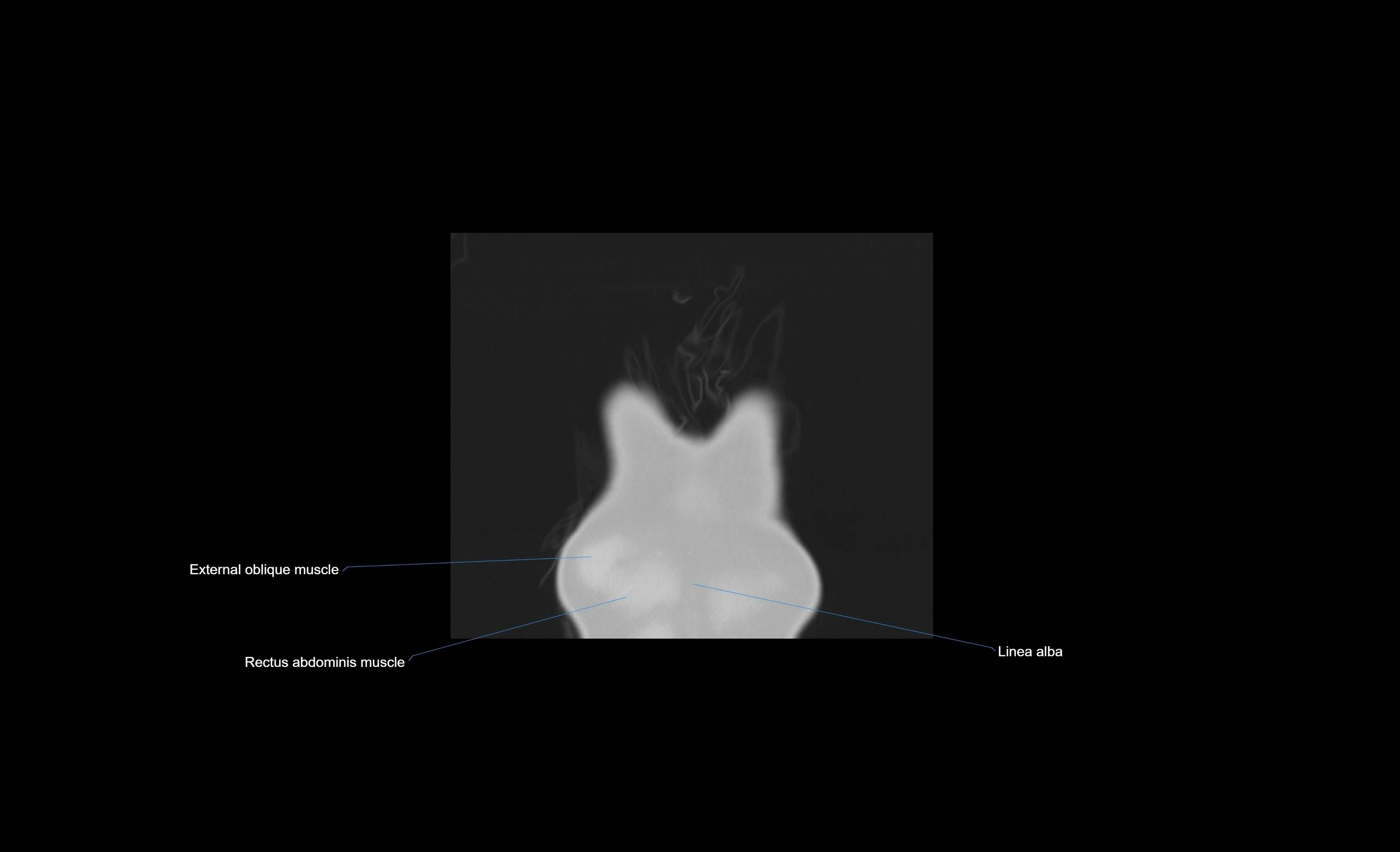 CT chest (thorax) lung window window labelled coronal cross sectional anatomy radiology image-00112.webp